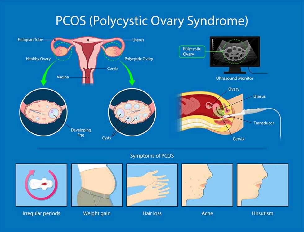 What is polycystic ovary syndrome? - The Center For Diabetes ...